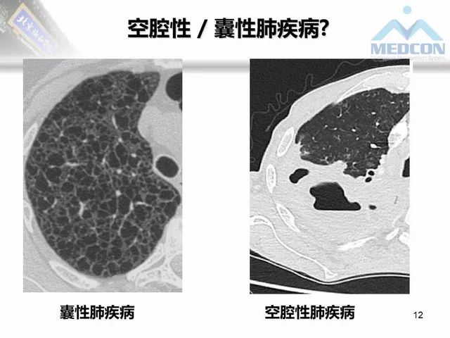 【PPT】肺气肿、囊性肺部疾病的影像学病因鉴别