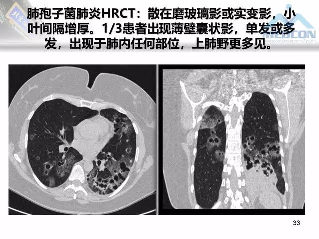 【PPT】肺气肿、囊性肺部疾病的影像学病因鉴别