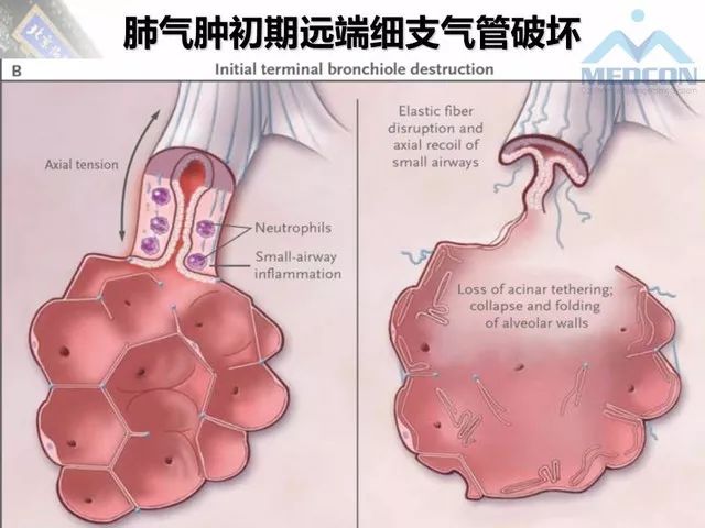 【PPT】肺气肿、囊性肺部疾病的影像学病因鉴别