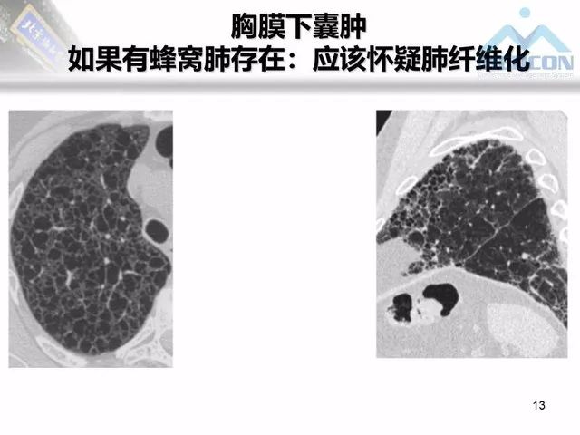 【PPT】肺气肿、囊性肺部疾病的影像学病因鉴别