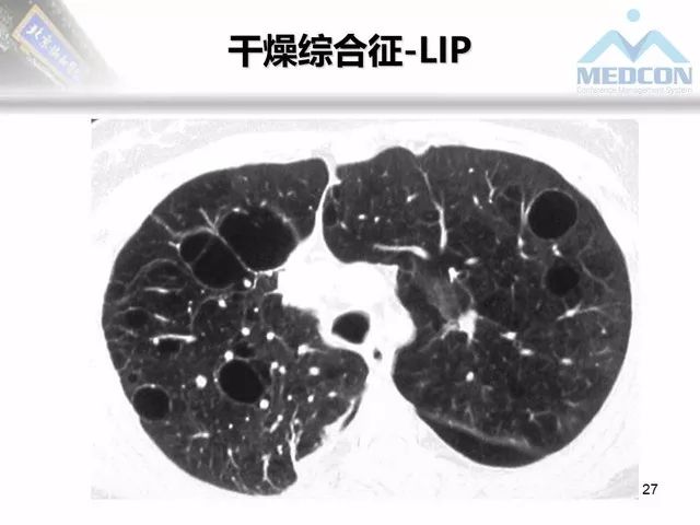 【PPT】肺气肿、囊性肺部疾病的影像学病因鉴别