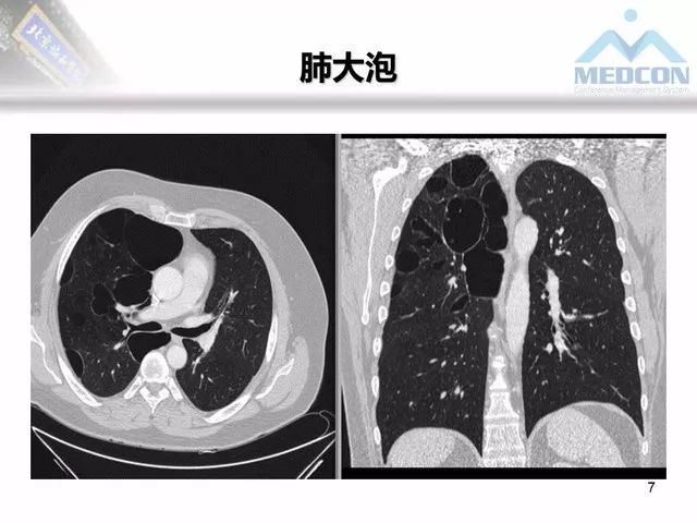 【PPT】肺气肿、囊性肺部疾病的影像学病因鉴别