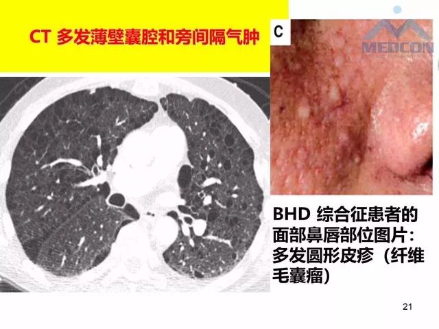 【PPT】肺气肿、囊性肺部疾病的影像学病因鉴别