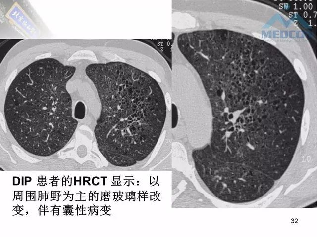 【PPT】肺气肿、囊性肺部疾病的影像学病因鉴别