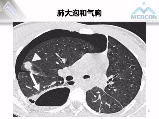 【PPT】肺气肿、囊性肺部疾病的影像学病因鉴别