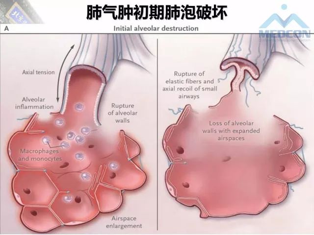 【PPT】肺气肿、囊性肺部疾病的影像学病因鉴别