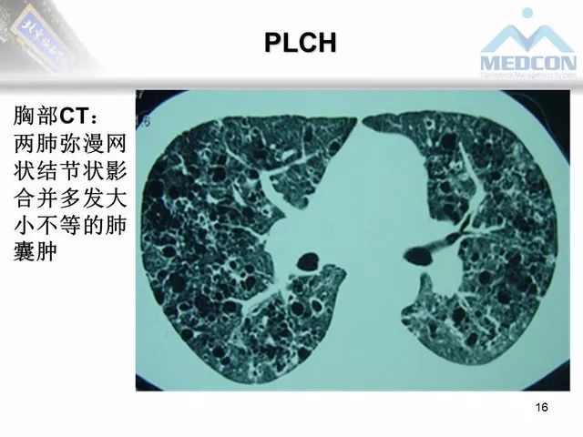 【PPT】肺气肿、囊性肺部疾病的影像学病因鉴别