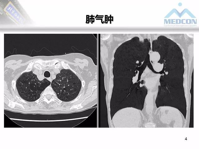 【PPT】肺气肿、囊性肺部疾病的影像学病因鉴别