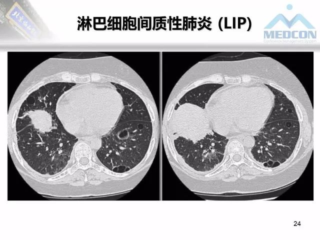 【PPT】肺气肿、囊性肺部疾病的影像学病因鉴别