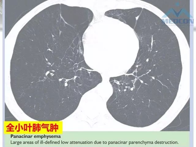 【PPT】肺气肿、囊性肺部疾病的影像学病因鉴别