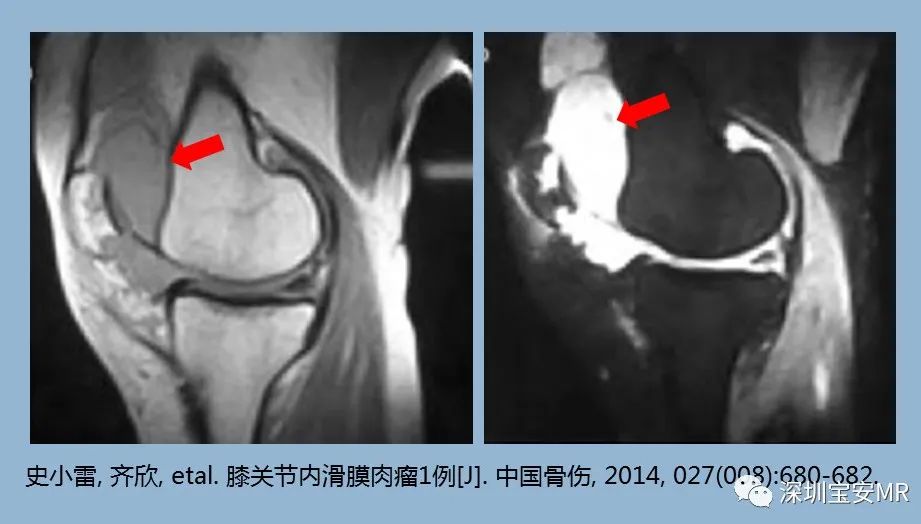 滑膜树枝状脂肪瘤
