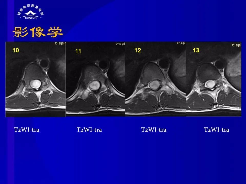 【病例】脊髓节细胞胶质瘤1例MR影像解析 【病例】脊髓节细胞胶质瘤1例MR影像解析