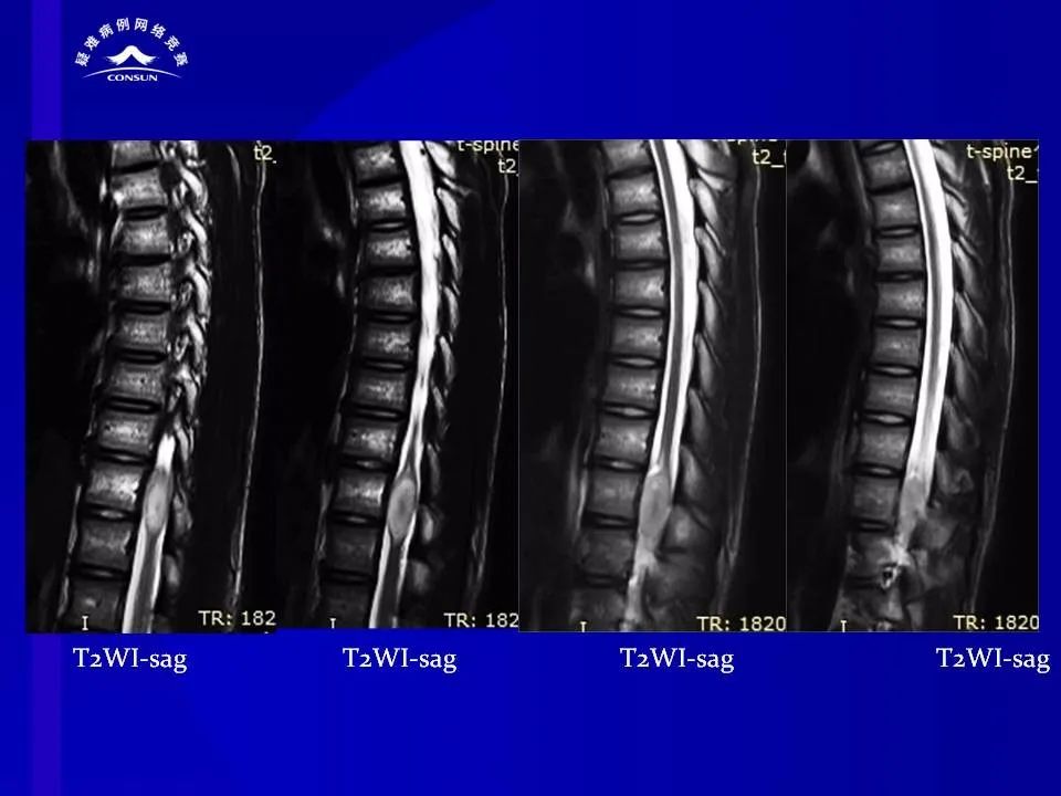 【病例】脊髓节细胞胶质瘤1例MR影像解析 【病例】脊髓节细胞胶质瘤1例MR影像解析