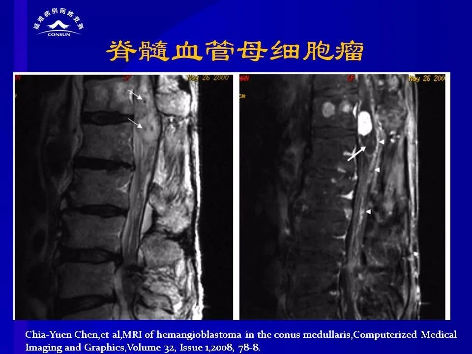 【病例】脊髓节细胞胶质瘤1例MR影像解析 【病例】脊髓节细胞胶质瘤1例MR影像解析