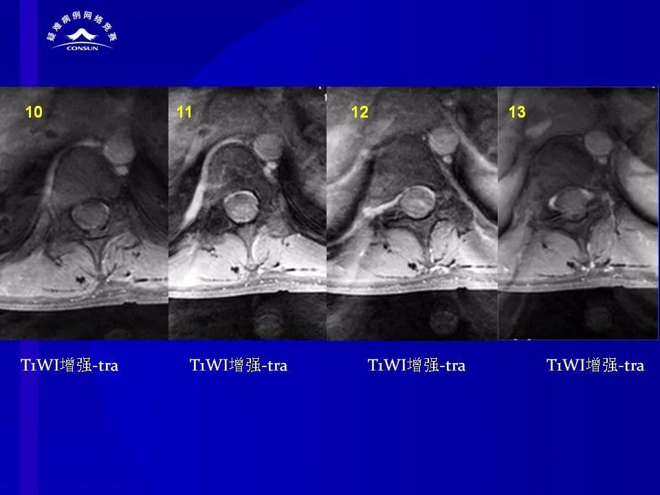 【病例】脊髓节细胞胶质瘤1例MR影像解析 【病例】脊髓节细胞胶质瘤1例MR影像解析