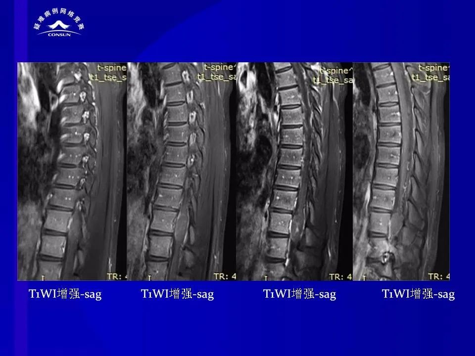 【病例】脊髓节细胞胶质瘤1例MR影像解析 【病例】脊髓节细胞胶质瘤1例MR影像解析