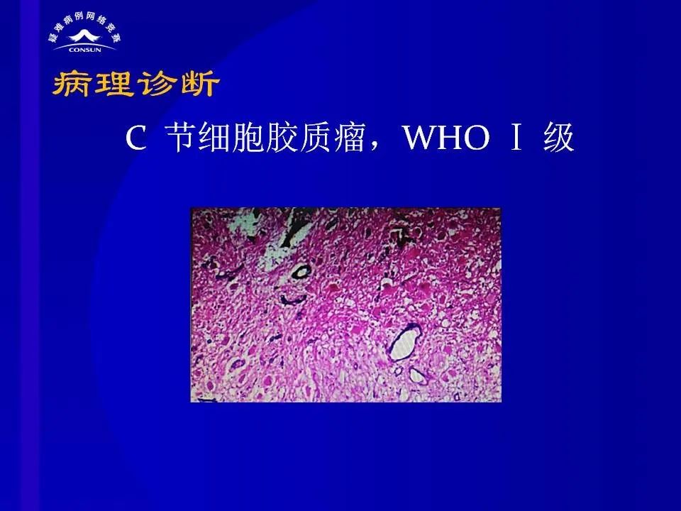 【病例】脊髓节细胞胶质瘤1例MR影像解析 【病例】脊髓节细胞胶质瘤1例MR影像解析