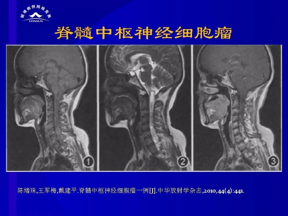 【病例】脊髓节细胞胶质瘤1例MR影像解析 【病例】脊髓节细胞胶质瘤1例MR影像解析