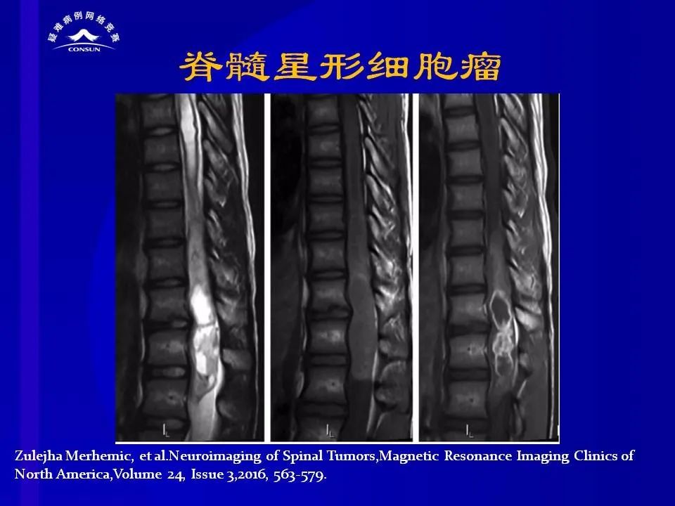 【病例】脊髓节细胞胶质瘤1例MR影像解析 【病例】脊髓节细胞胶质瘤1例MR影像解析