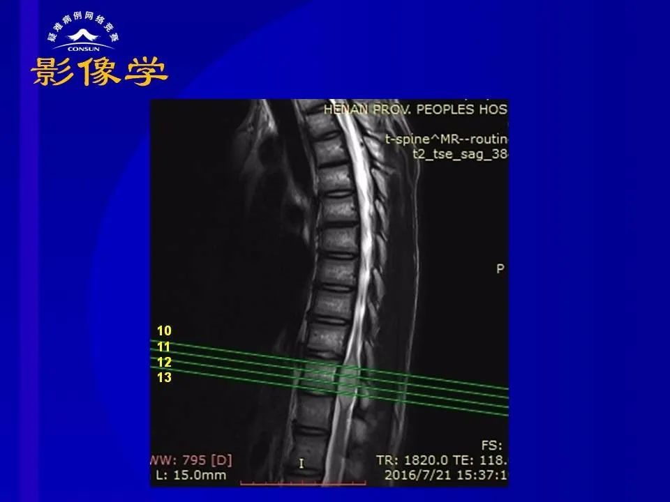 【病例】脊髓节细胞胶质瘤1例MR影像解析 【病例】脊髓节细胞胶质瘤1例MR影像解析