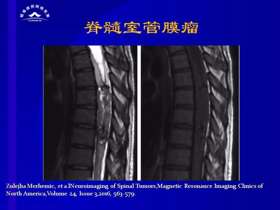 【病例】脊髓节细胞胶质瘤1例MR影像解析 【病例】脊髓节细胞胶质瘤1例MR影像解析