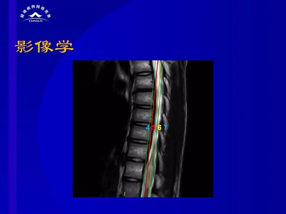 【病例】脊髓节细胞胶质瘤1例MR影像解析 【病例】脊髓节细胞胶质瘤1例MR影像解析