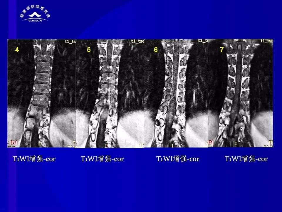 【病例】脊髓节细胞胶质瘤1例MR影像解析 【病例】脊髓节细胞胶质瘤1例MR影像解析