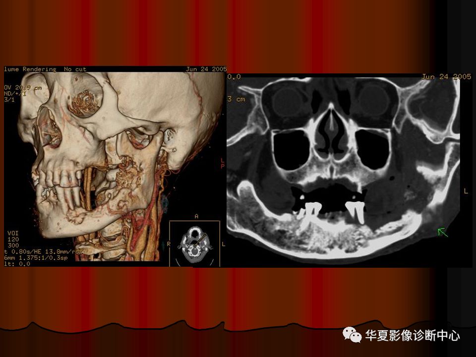 【PPT】口腔颌面部CT诊断 【PPT】口腔颌面部CT诊断