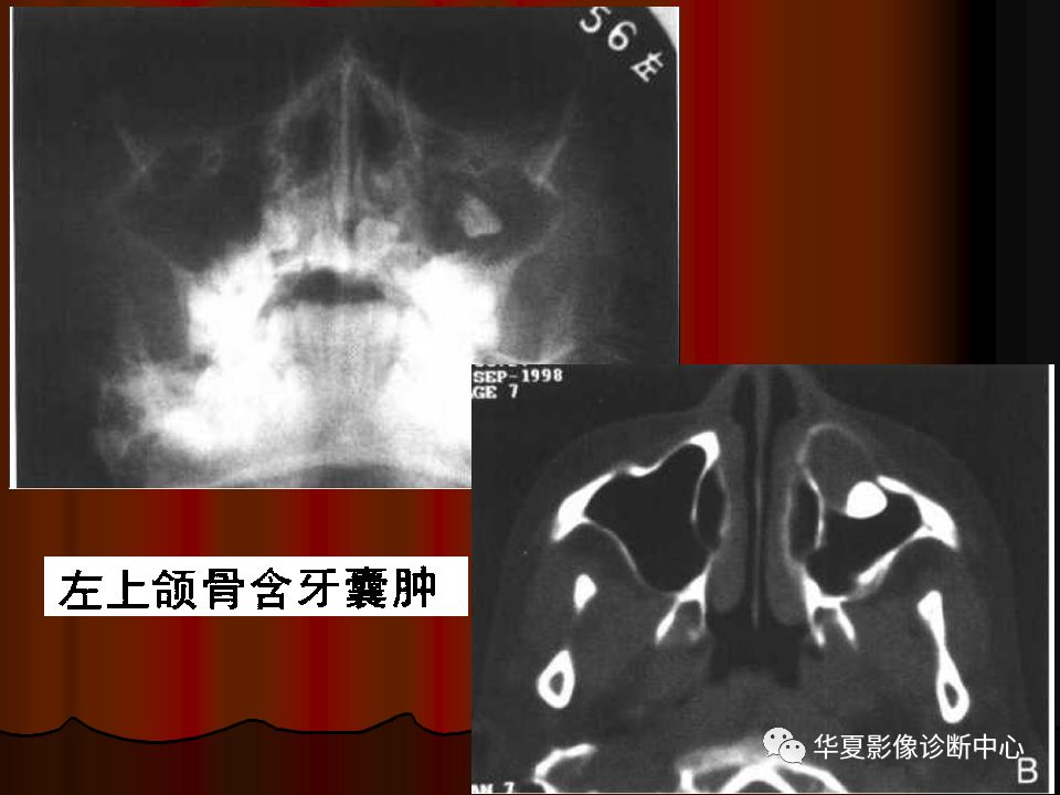 【PPT】口腔颌面部CT诊断 【PPT】口腔颌面部CT诊断