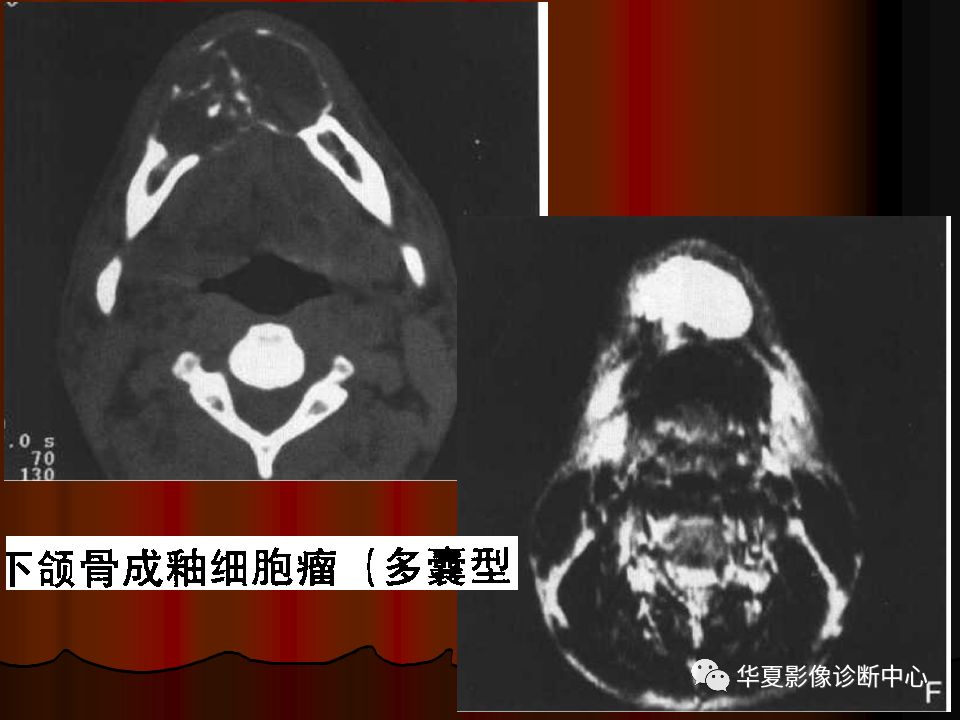 【PPT】口腔颌面部CT诊断 【PPT】口腔颌面部CT诊断