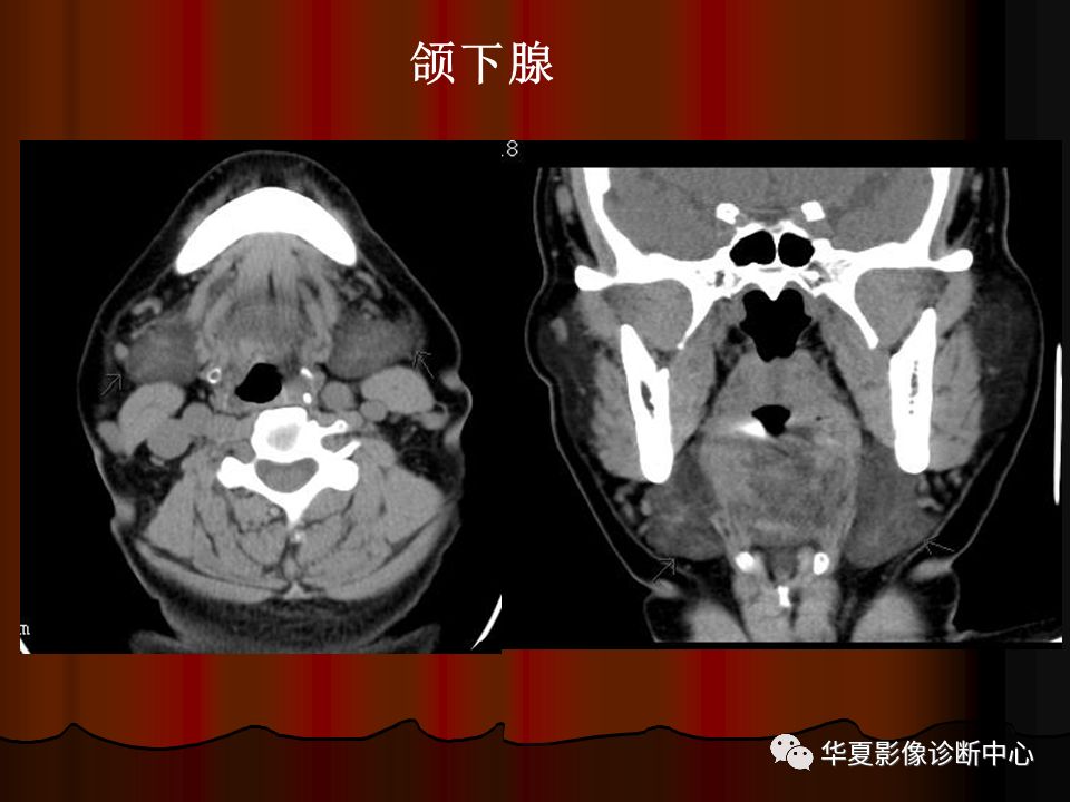 【PPT】口腔颌面部CT诊断 【PPT】口腔颌面部CT诊断