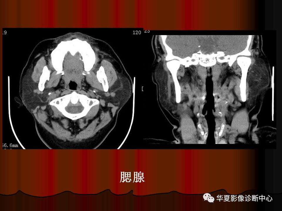 【PPT】口腔颌面部CT诊断 【PPT】口腔颌面部CT诊断