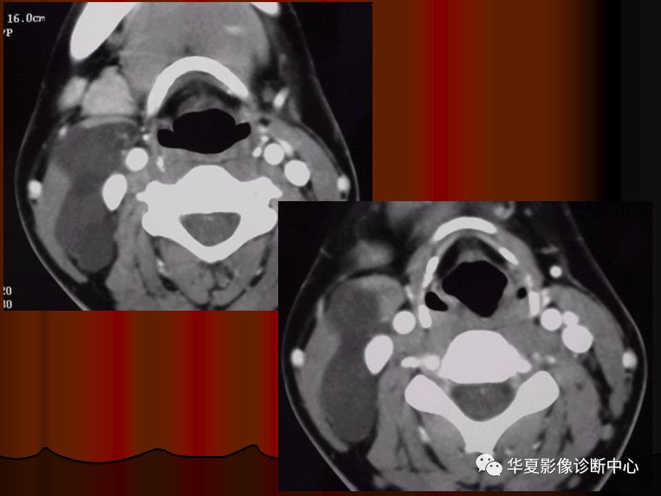 【PPT】口腔颌面部CT诊断 【PPT】口腔颌面部CT诊断