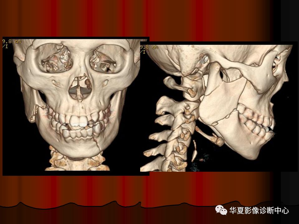 【PPT】口腔颌面部CT诊断 【PPT】口腔颌面部CT诊断