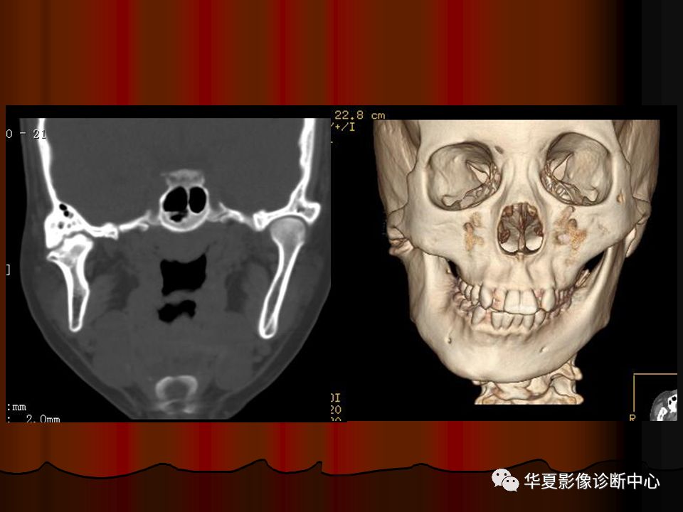 【PPT】口腔颌面部CT诊断 【PPT】口腔颌面部CT诊断