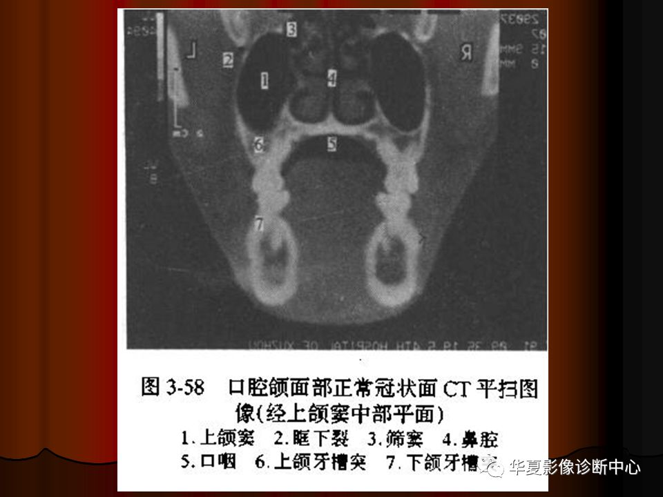 【PPT】口腔颌面部CT诊断 【PPT】口腔颌面部CT诊断