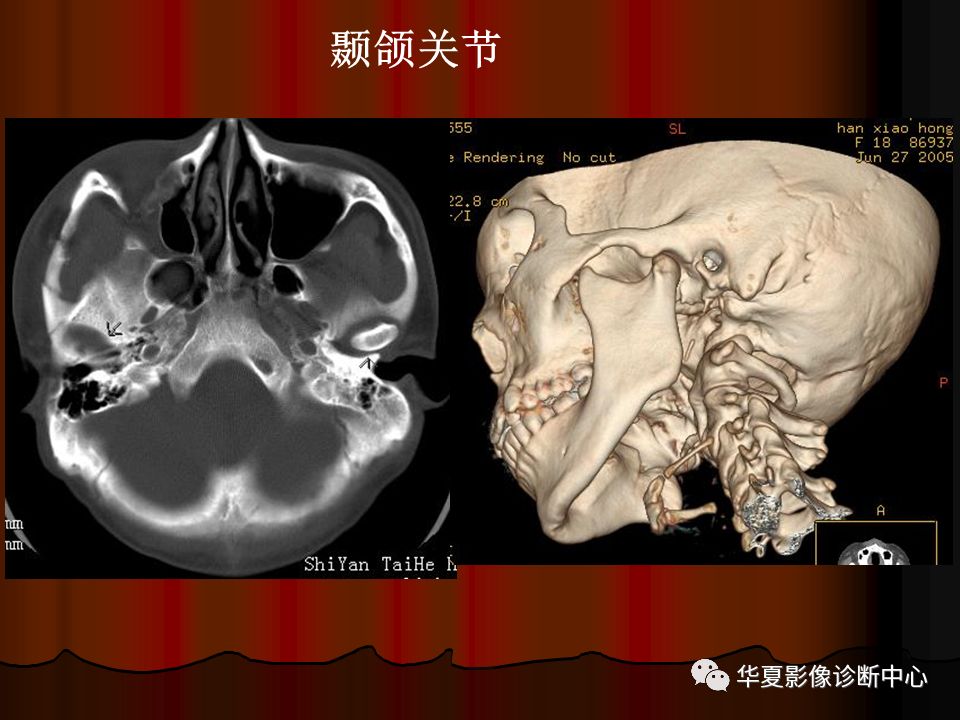 【PPT】口腔颌面部CT诊断 【PPT】口腔颌面部CT诊断
