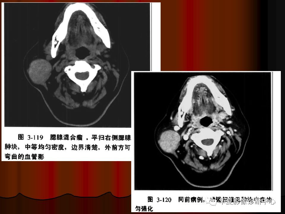 【PPT】口腔颌面部CT诊断 【PPT】口腔颌面部CT诊断