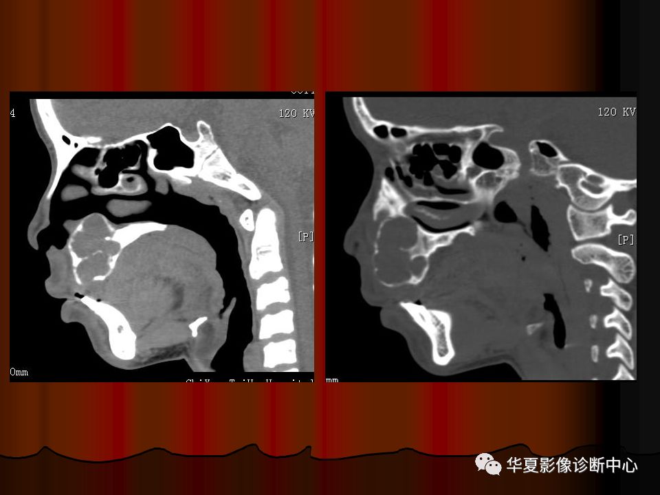 【PPT】口腔颌面部CT诊断 【PPT】口腔颌面部CT诊断