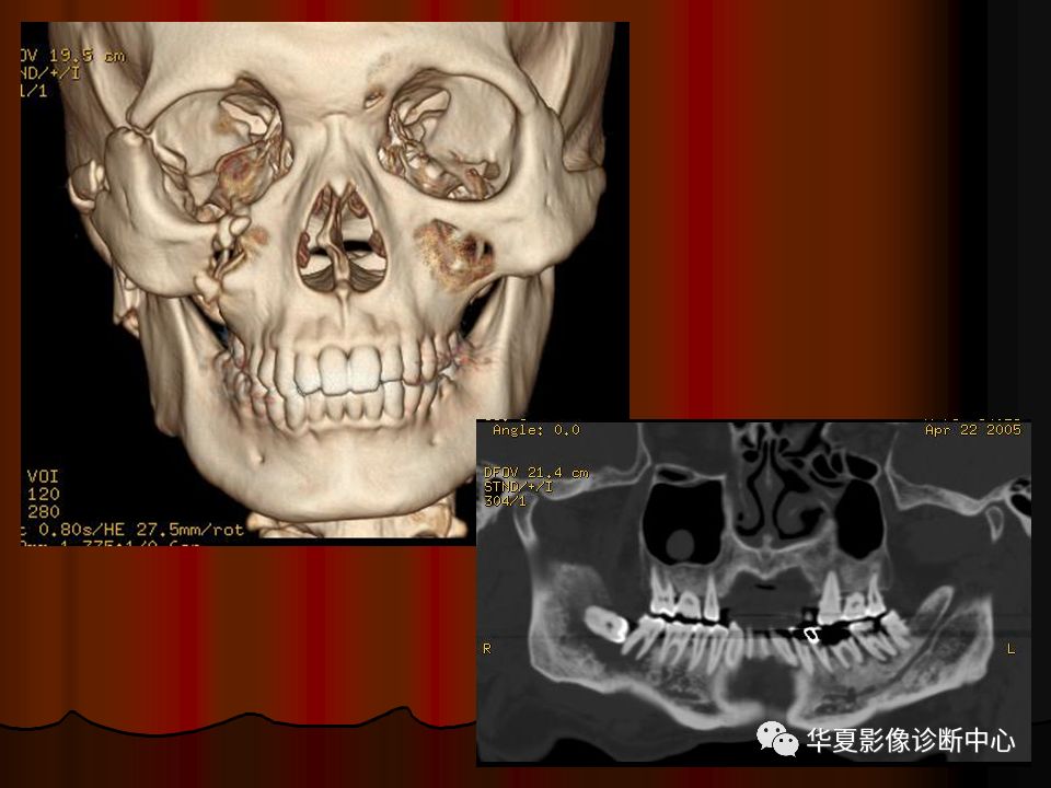 【PPT】口腔颌面部CT诊断 【PPT】口腔颌面部CT诊断