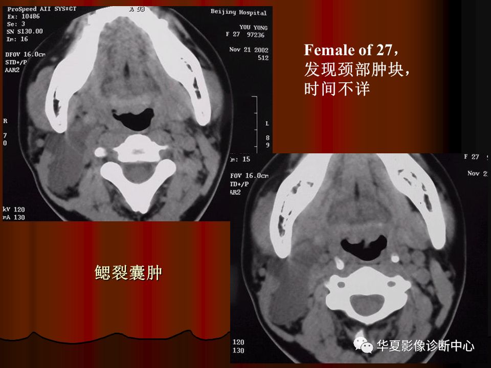【PPT】口腔颌面部CT诊断 【PPT】口腔颌面部CT诊断