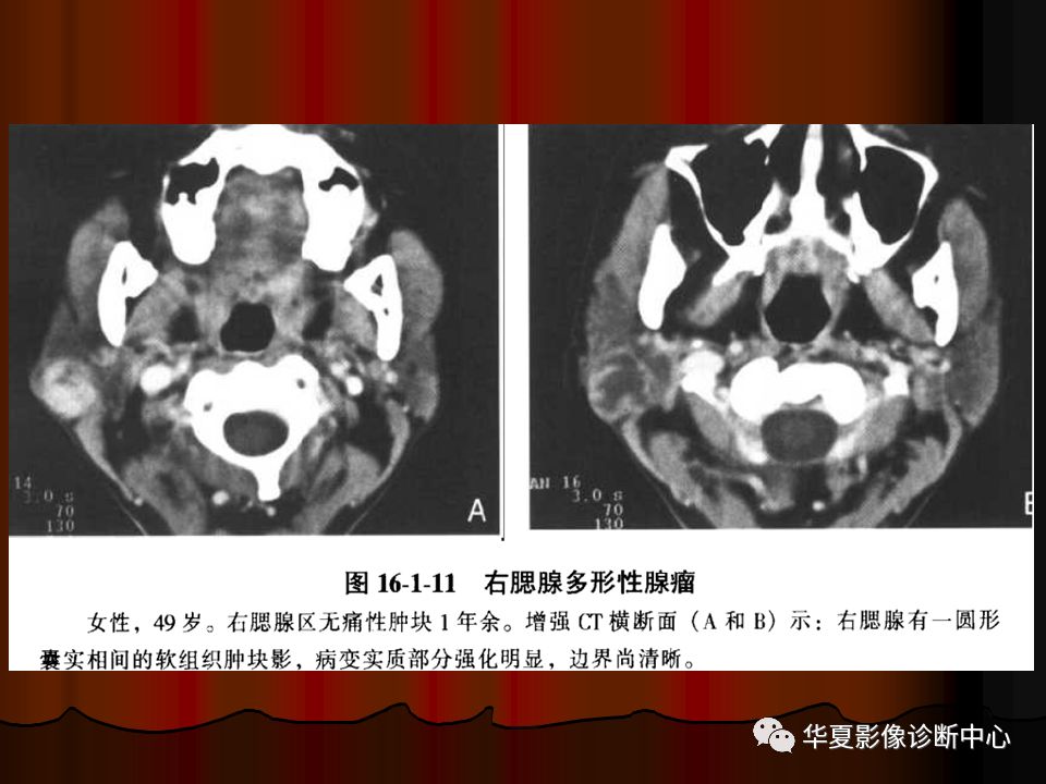 【PPT】口腔颌面部CT诊断 【PPT】口腔颌面部CT诊断