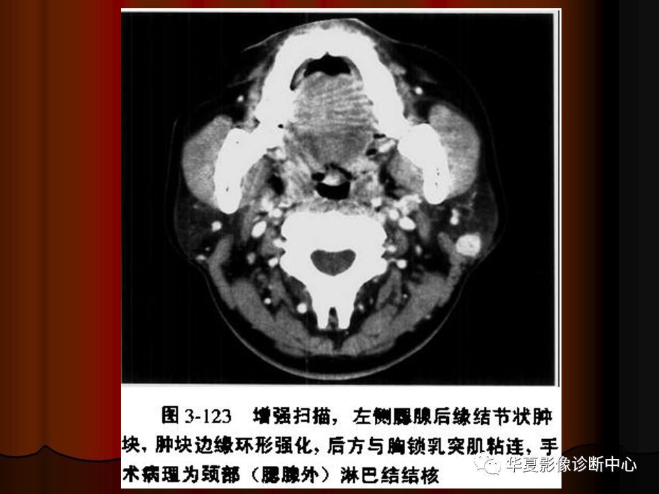 【PPT】口腔颌面部CT诊断 【PPT】口腔颌面部CT诊断