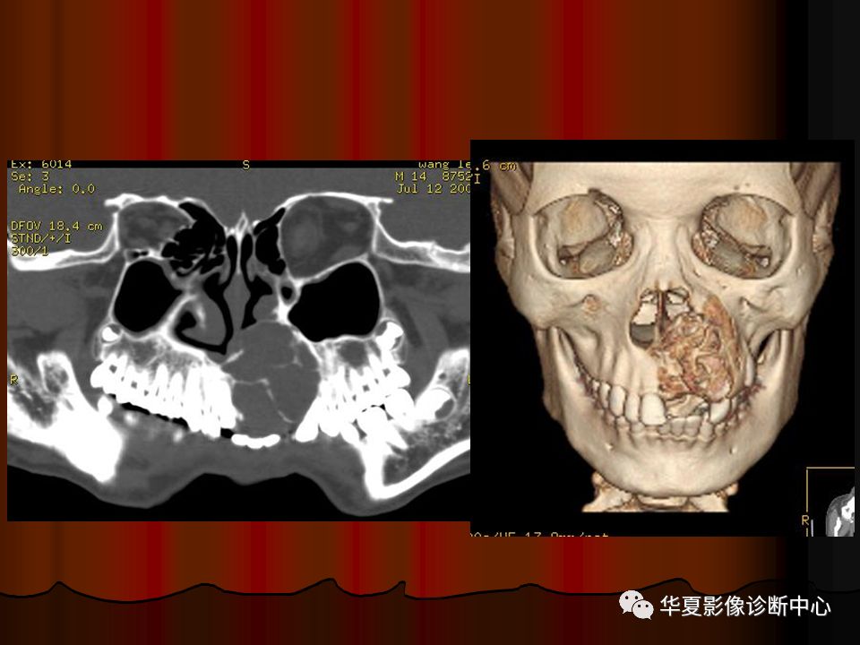 【PPT】口腔颌面部CT诊断 【PPT】口腔颌面部CT诊断