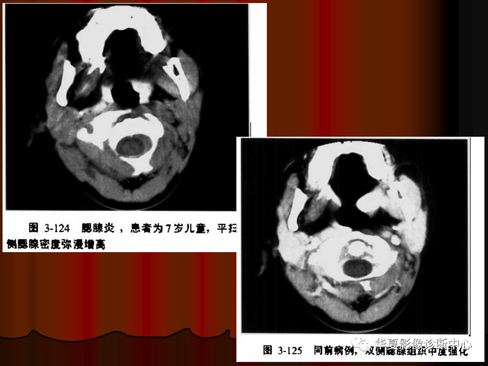 【PPT】口腔颌面部CT诊断 【PPT】口腔颌面部CT诊断