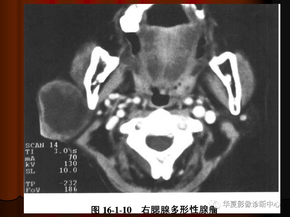 【PPT】口腔颌面部CT诊断 【PPT】口腔颌面部CT诊断