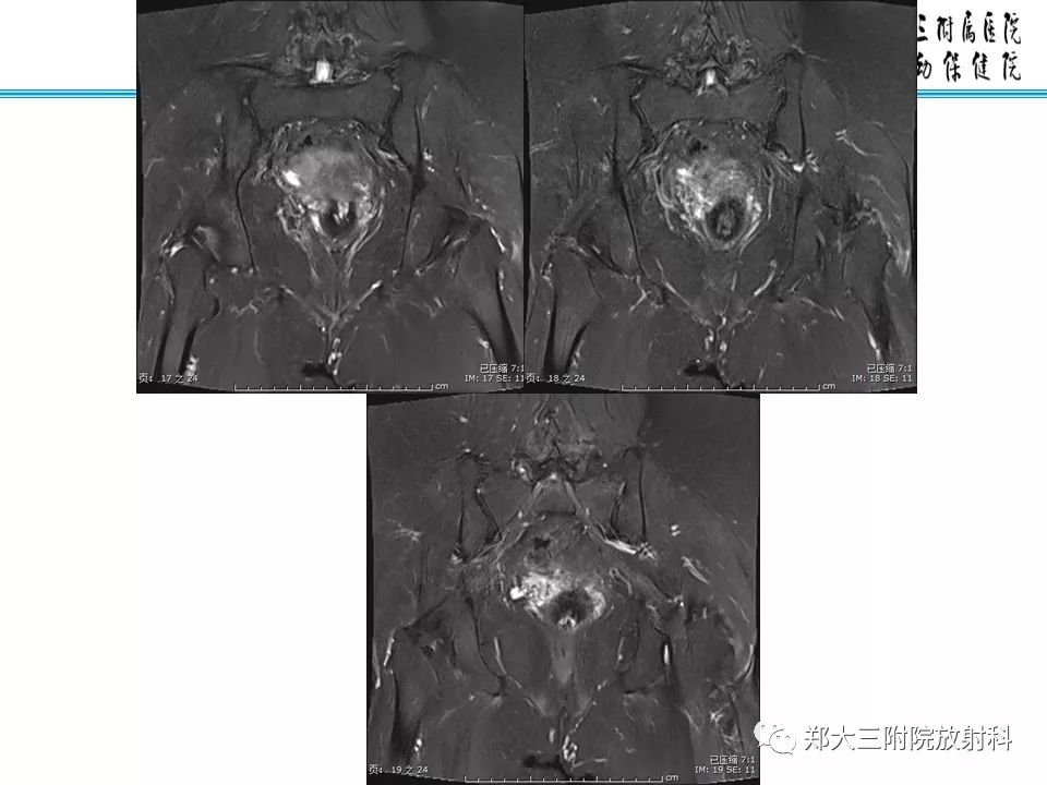 【PPT】如何判断盆腔肿瘤恶性淋巴结的转移 【PPT】如何判断盆腔肿瘤恶性淋巴结的转移