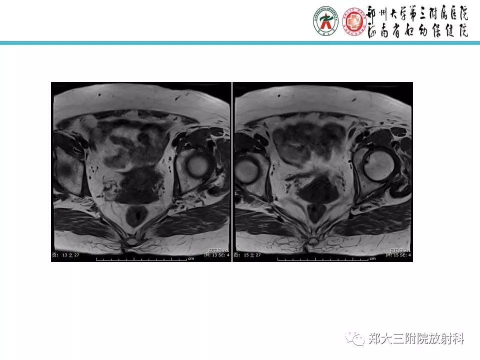 【PPT】如何判断盆腔肿瘤恶性淋巴结的转移 【PPT】如何判断盆腔肿瘤恶性淋巴结的转移