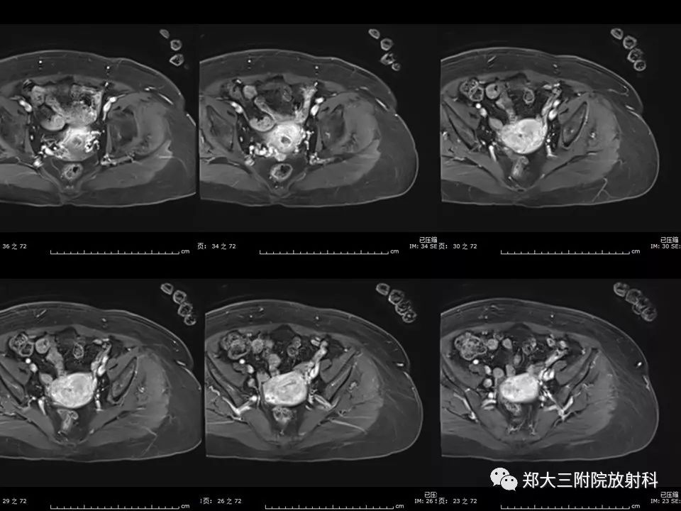 【PPT】如何判断盆腔肿瘤恶性淋巴结的转移 【PPT】如何判断盆腔肿瘤恶性淋巴结的转移