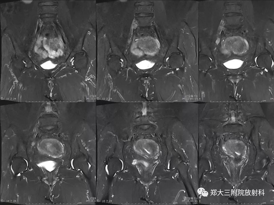 【PPT】如何判断盆腔肿瘤恶性淋巴结的转移 【PPT】如何判断盆腔肿瘤恶性淋巴结的转移